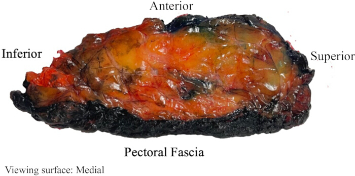 Dissection of human pectoral fascia; labeled parts; anatomical study; educational diagram.