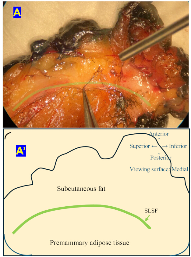 Subcutaneous fat and premammary adipose tissue dissection with diagram indicating anatomical orientation.