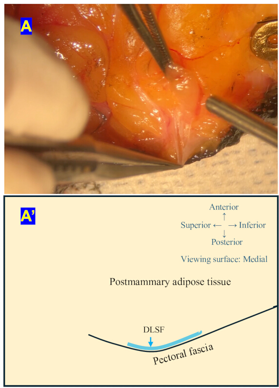 Postmammary adipose tissue dissection; diagram of anatomical layers; surgical study.