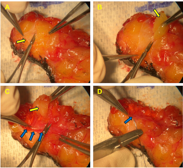 Surgical procedure extracting tissue from specimen; process steps A-D; dissecting tools shown.