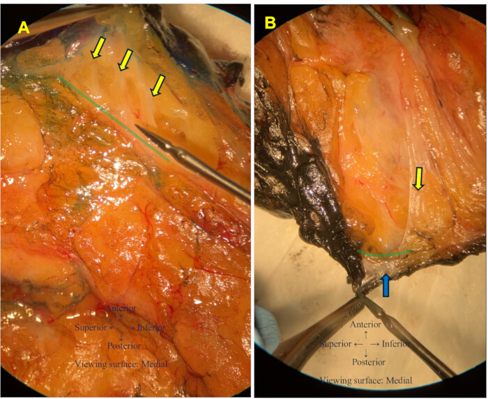 "<75 characters)"

Anatomy dissection diagram, identifying tendon and muscle orientation.