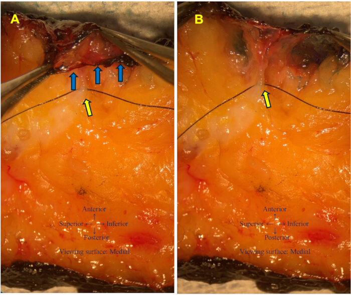 Medial shoulder anatomical dissection, arrows indicating tissue layers comparison; educational use.