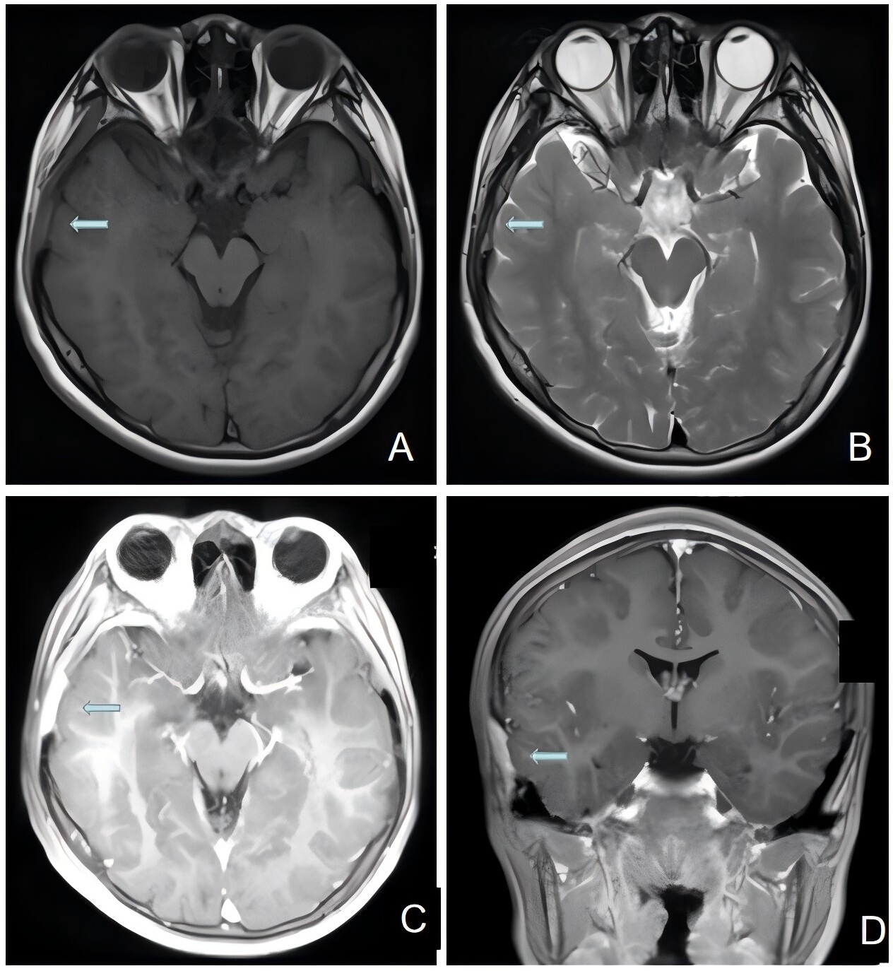 Video: Aggressive Langerhans Cell Histiocytosis (LCH) of Right Temporal ...