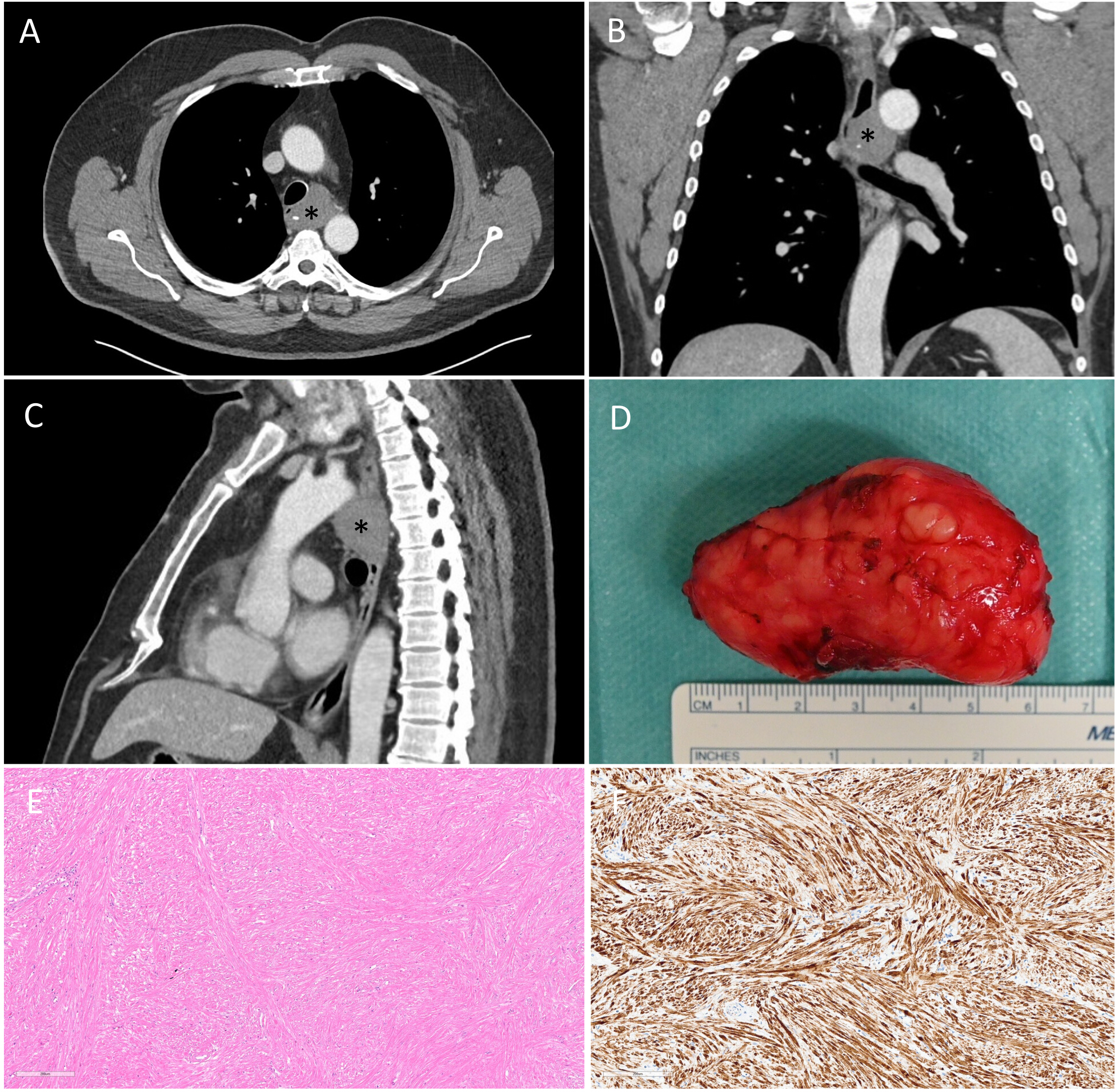 Enucleating Robotic Enucleation of Esophageal Leiomyoma