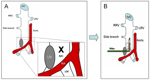 figure-protocol-1 Endovascular procedure diagram showing IVC, aorta, and wire insertion for vascular access.