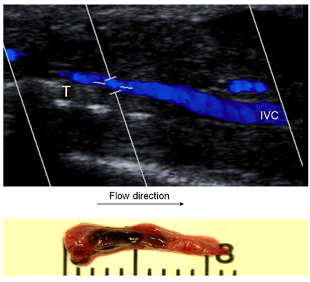 figure-protocol-5 Ultrasound imaging, venous flow direction, thrombosis detection, medical analysis.