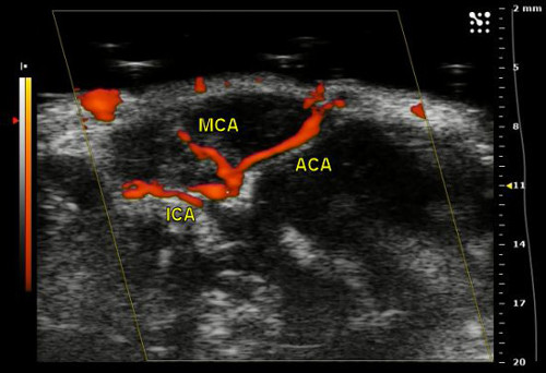 figure-results-11 Transcranial Doppler ultrasound, MCA, ACA, ICA, cerebral blood flow, brain vessel imaging diagram.