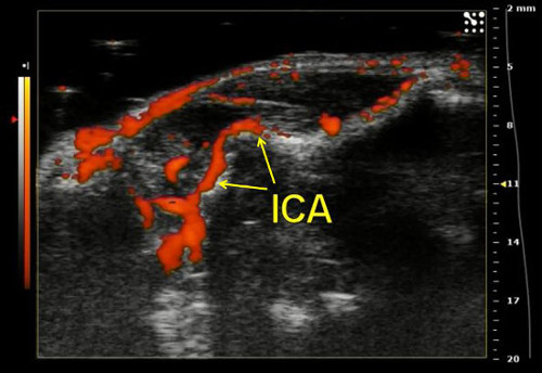 figure-results-12 Ultrasound Doppler scan showing internal carotid artery flow, labeled "ICA," in vascular study.