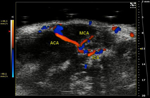figure-results-13 Brain blood flow analysis, color Doppler ultrasound, ACA, MCA, ICA, vascular examination, flow velocity.