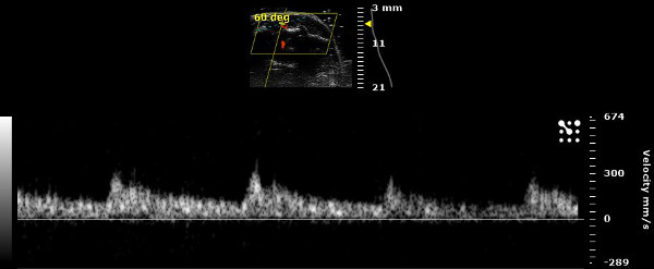 figure-results-14 Doppler ultrasound diagram; velocity vs distance graph; blood flow analysis; diagnostic imaging.