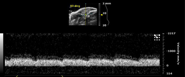 figure-results-15 Ultrasound imaging; Doppler effect; blood flow analysis; velocity/time graph; medical diagnostics.