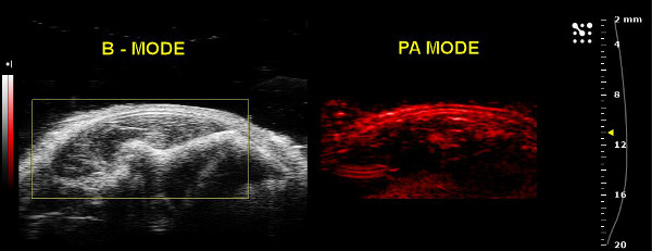figure-results-16 B-mode and PA-mode imaging; ultrasound and photoacoustic tomography; diagnostic method comparison.