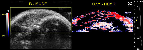 figure-results-17 B-mode ultrasound and oxy-hemo imaging, blood oxygen level analysis in medical diagnostics.