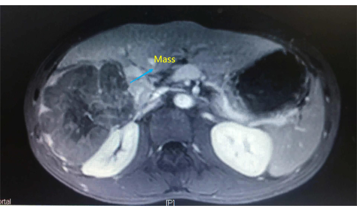 figure-results-1 Abdominal MRI scan showing mass detection, diagnostic imaging, radiology analysis, tumor identification.