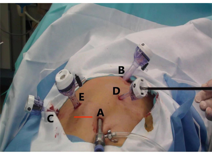figure-results-2 Laparoscopic surgery setup with trocars; minimally invasive procedure demonstration.