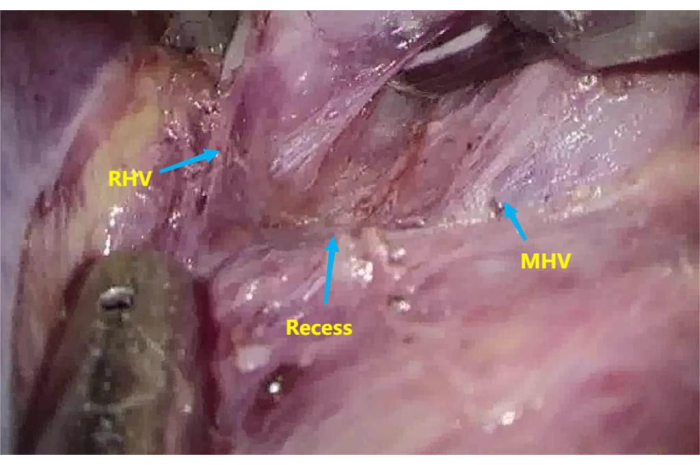 figure-results-3 Anatomy diagram highlighting RHV, MHV, and Recess; surgical perspective of liver veins.
