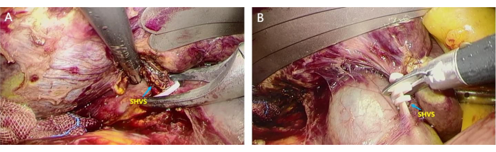 figure-results-4 Surgical procedure showing liver vein stapling steps with SHVS indicator, medical operation process.