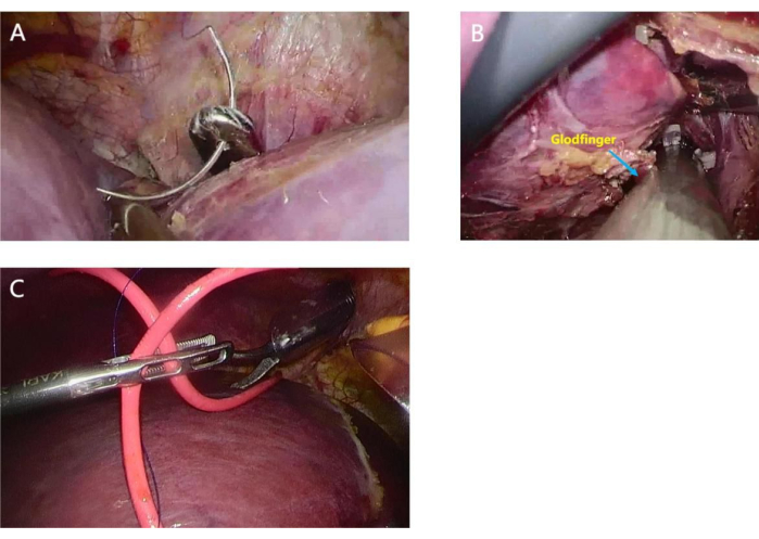 figure-results-5 Surgical knot tying, laparoscopic procedure, close-up images showing techniques and tools.
