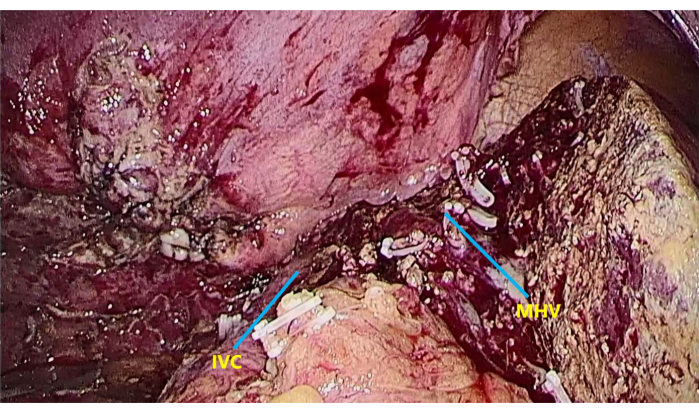 figure-results-7 Surgical anatomy illustration showing inferior vena cava (IVC) and middle hepatic vein (MHV).