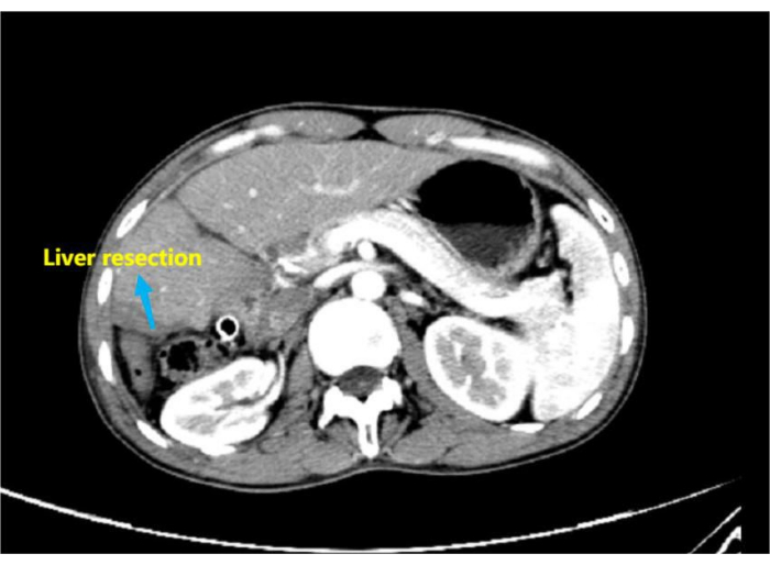 figure-results-8 CT scan showing liver resection area; medical imaging, surgery planning, post-operative analysis.