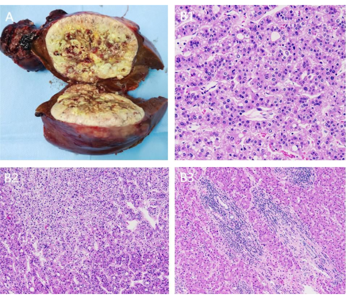 figure-results-9 Gross liver section and histology images; liver fibrosis, cellular morphology, microscopic analysis.