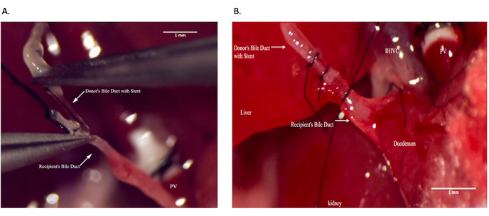 figure-results-9 Anastomose do ducto biliar com stent em transplante hepático; procedimento cirúrgico, imagem macro, configuração detalhada.
